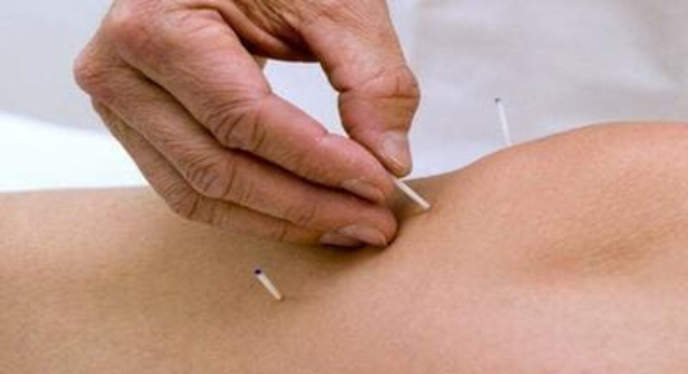 Acupuncture pour maigrir : peut on maigrir avec l acupuncture ?