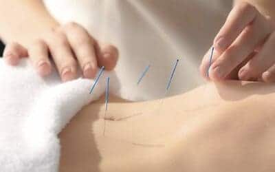 acupuncture pour perdre du poids