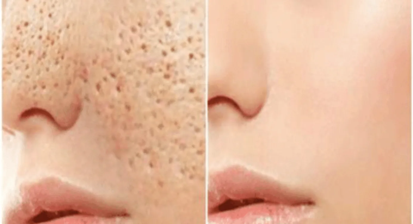 Comment refermer les pores naturellement ?