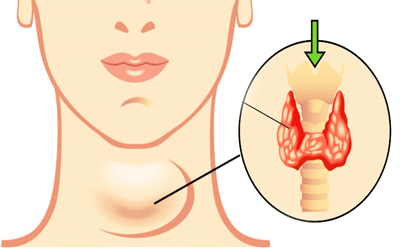 Hypothyroïdie hashimoto ( thyroïdite auto-immune)