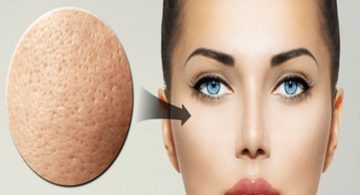 Pore dilaté : que faire ?