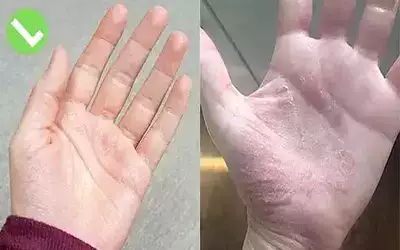 Comment traiter l eczéma naturellement1