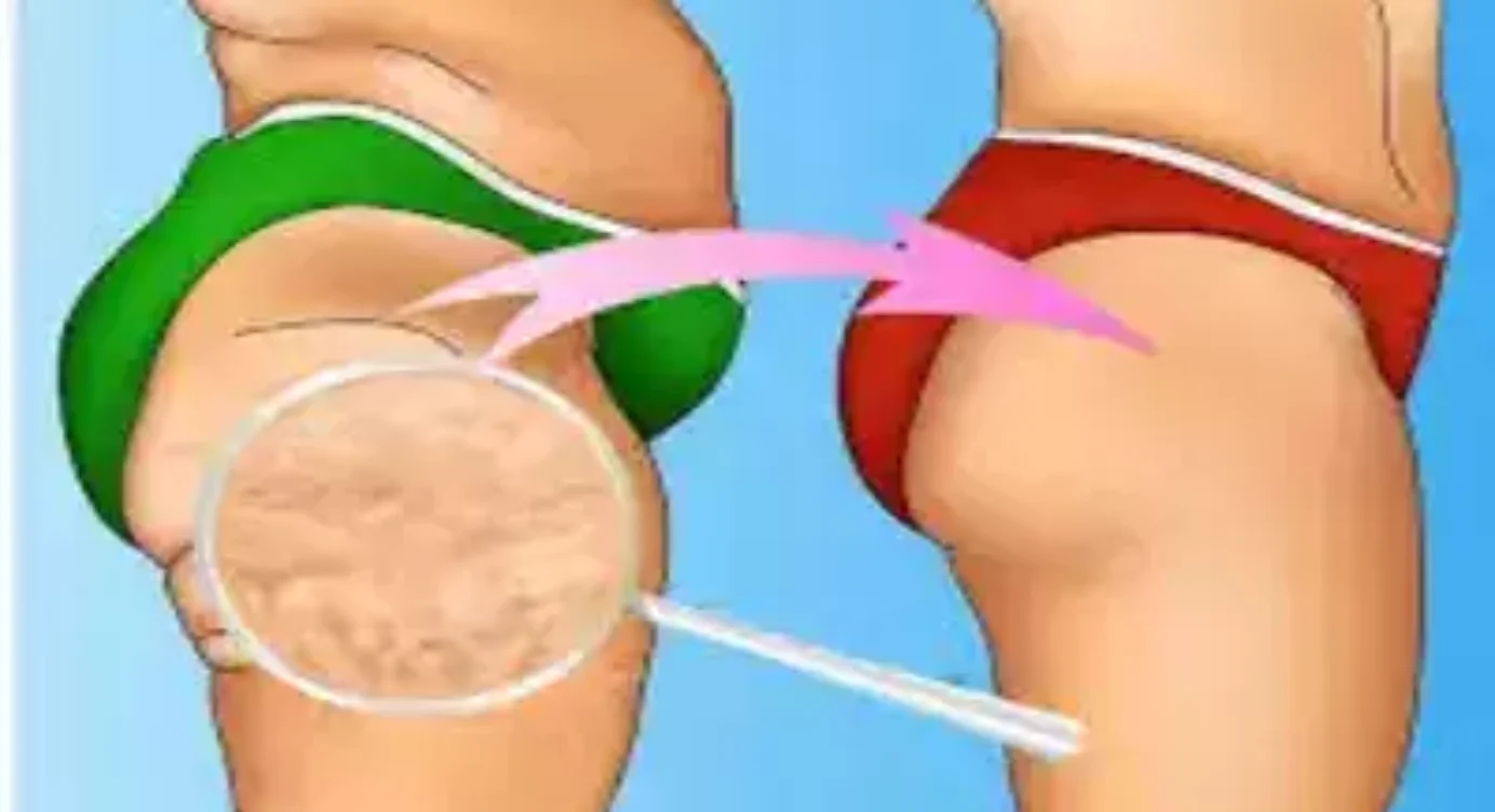 10 remèdes efficaces pour éliminer la cellulite naturellement