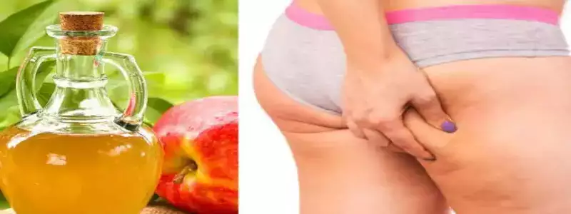 Le vinaigre de cidre de pomme pour éliminer la cellulite